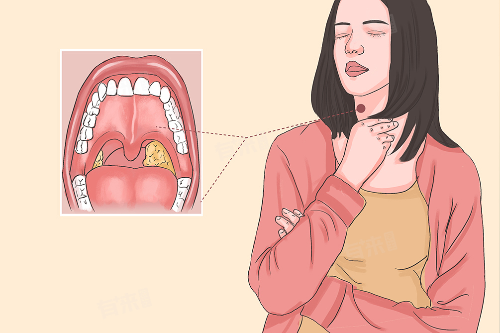 女子上厕所闻到恶臭当晚扁桃体发炎，一次意外引发的健康警钟